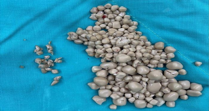Kadının böbreklerinden 300 taş çıkarıldı